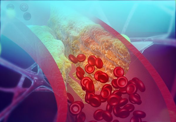 Cholesterol: The Good, the Bad and the Dietary